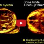 Spina bifida: 3D ultrasound diagnosis at 11-13 weeks