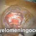 شاهد العملية الجراحية للحالة المتقدمة من الصلب المشقوق Myelomeningocele repair