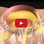 فيديو رسوم متحركة يشرح كيف يحدث الصلب المشقوق