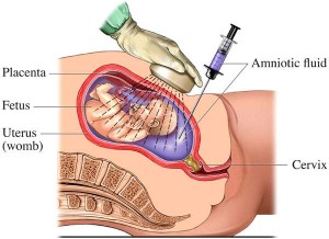 amniotic-fluid