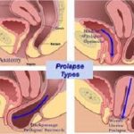 Uterine prolapse